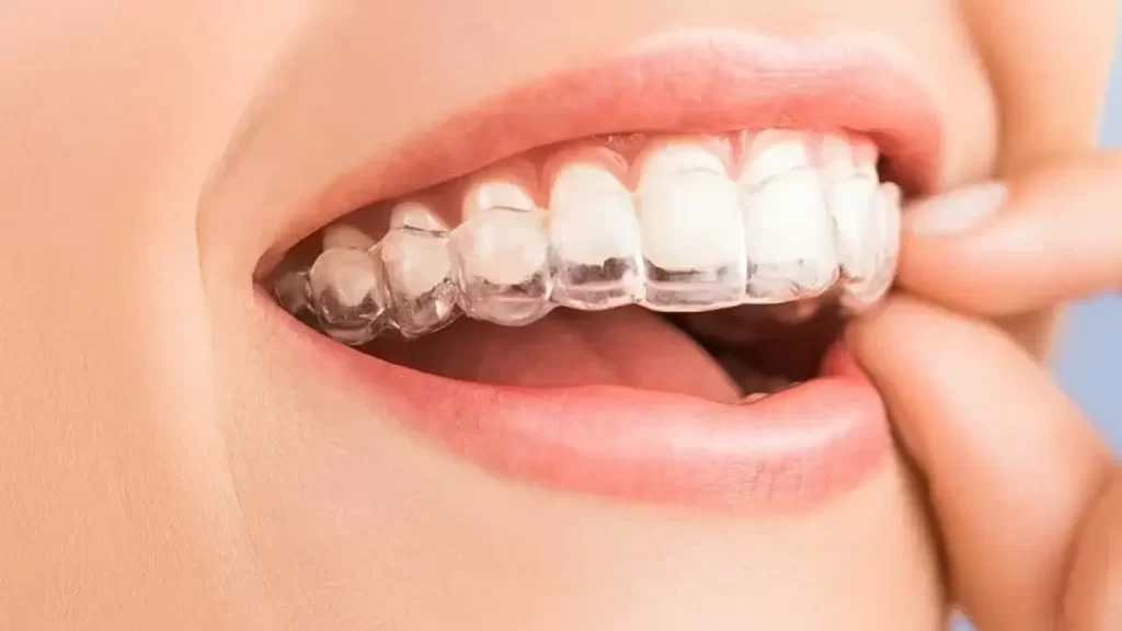 braces aligners