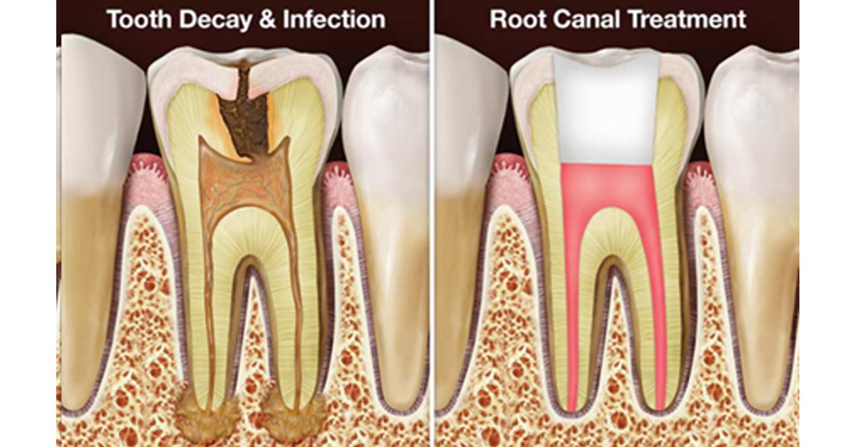 Root Canal Treatment Image