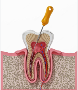 Root canal representation
