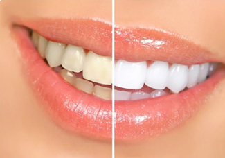 Whitened Teeth